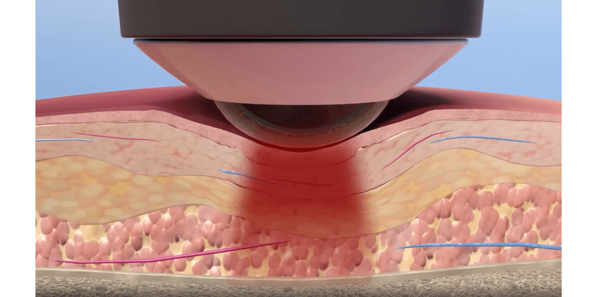 Photobiomodulation Therapy Comes of Age